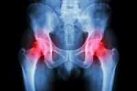 L’arthrose de hanche et ostéopathie